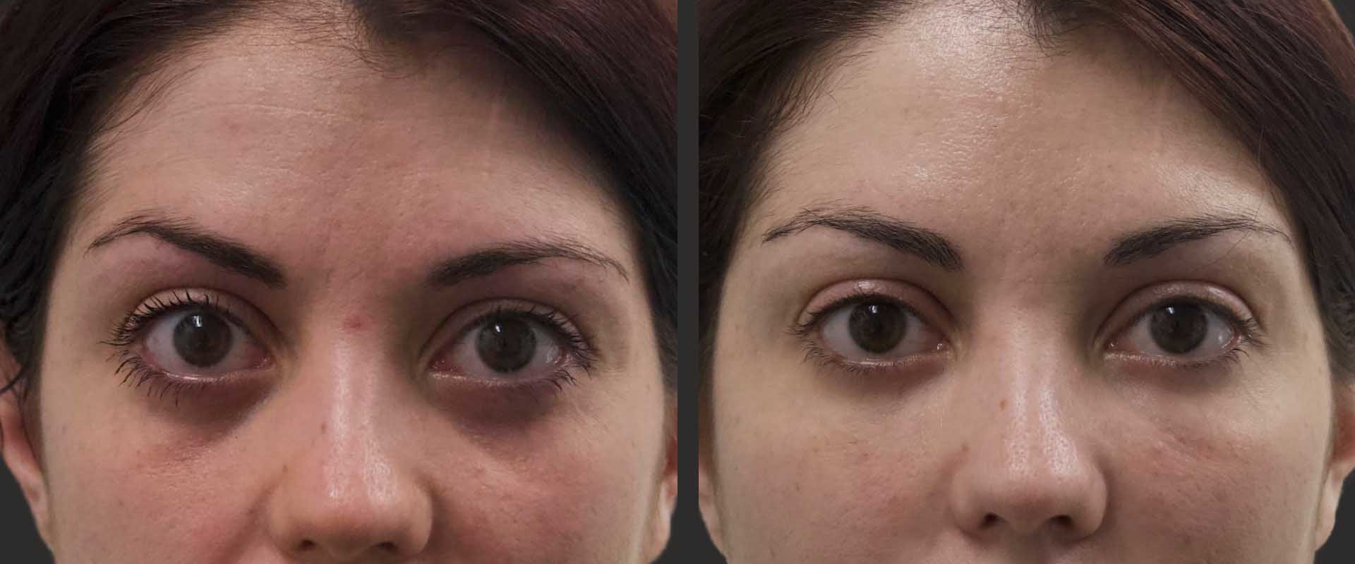 From Reiki to Radiance: Why More People Are Choosing Fillers in Zürich for a Refreshed Appearance
