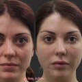 From Reiki to Radiance: Why More People Are Choosing Fillers in Zürich for a Refreshed Appearance