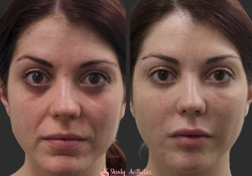From Reiki to Radiance: Why More People Are Choosing Fillers in Zürich for a Refreshed Appearance